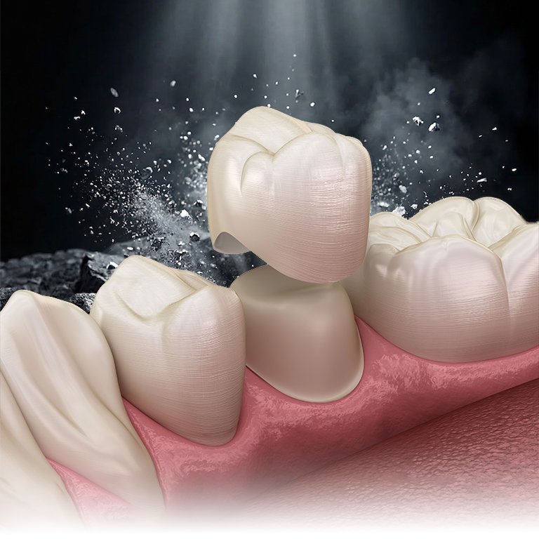 Zirconium Crowns
