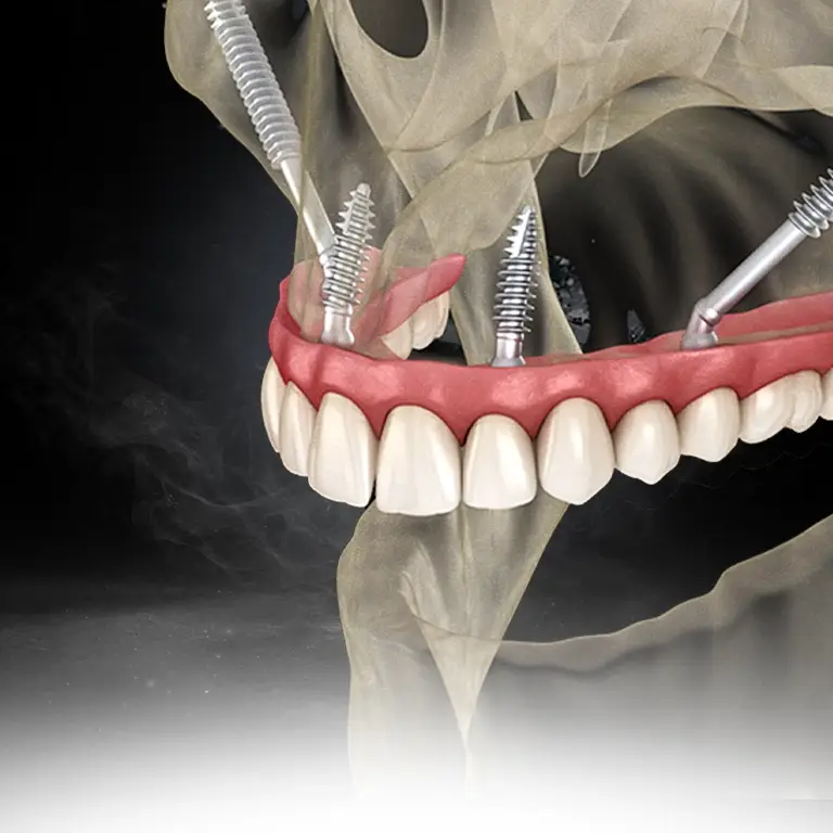 Zygomatic Implants
