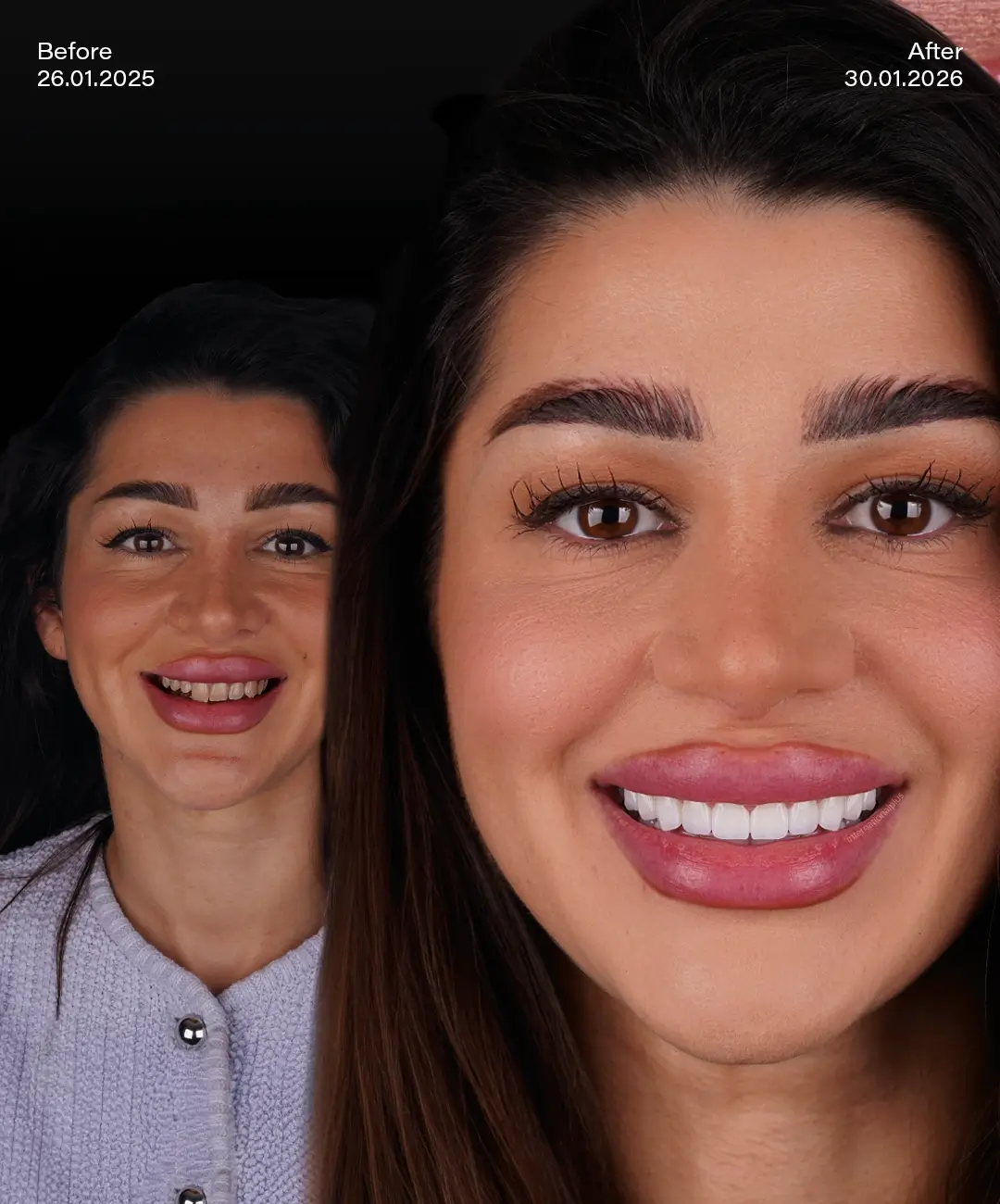 Hollywood smile