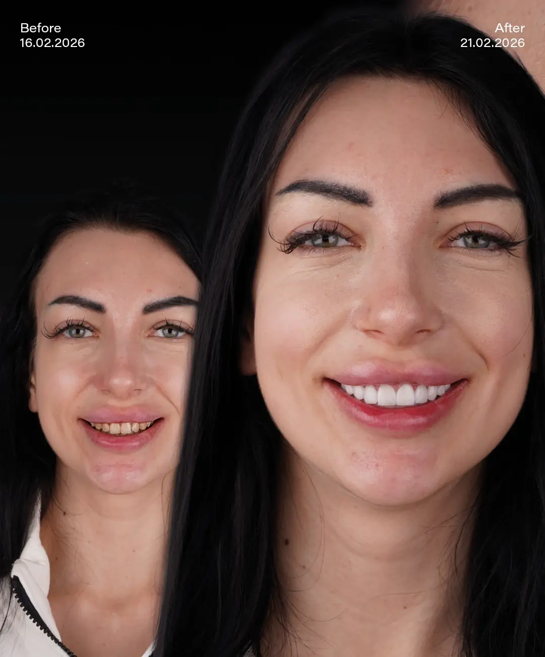 Laminate veneers