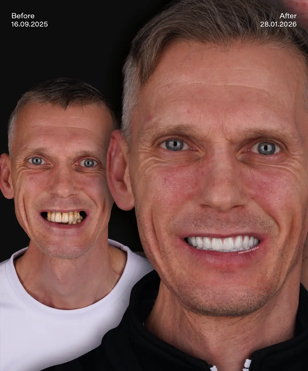 Zygomatic