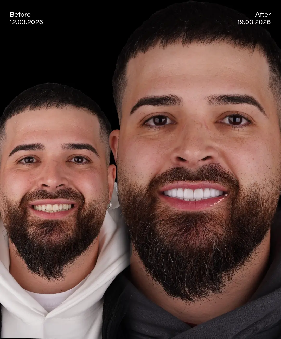 Lamine Veneers Before After 1