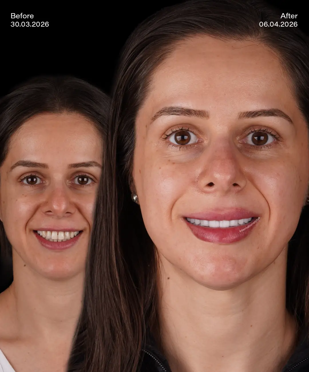 Lamine Veneers Before After 7