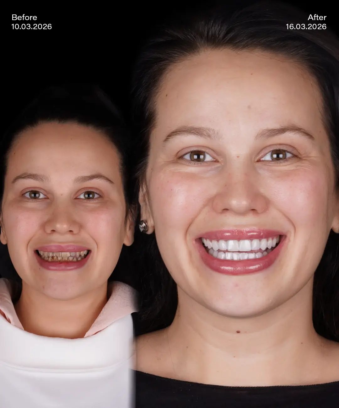 Lamine Veneers Before After 8