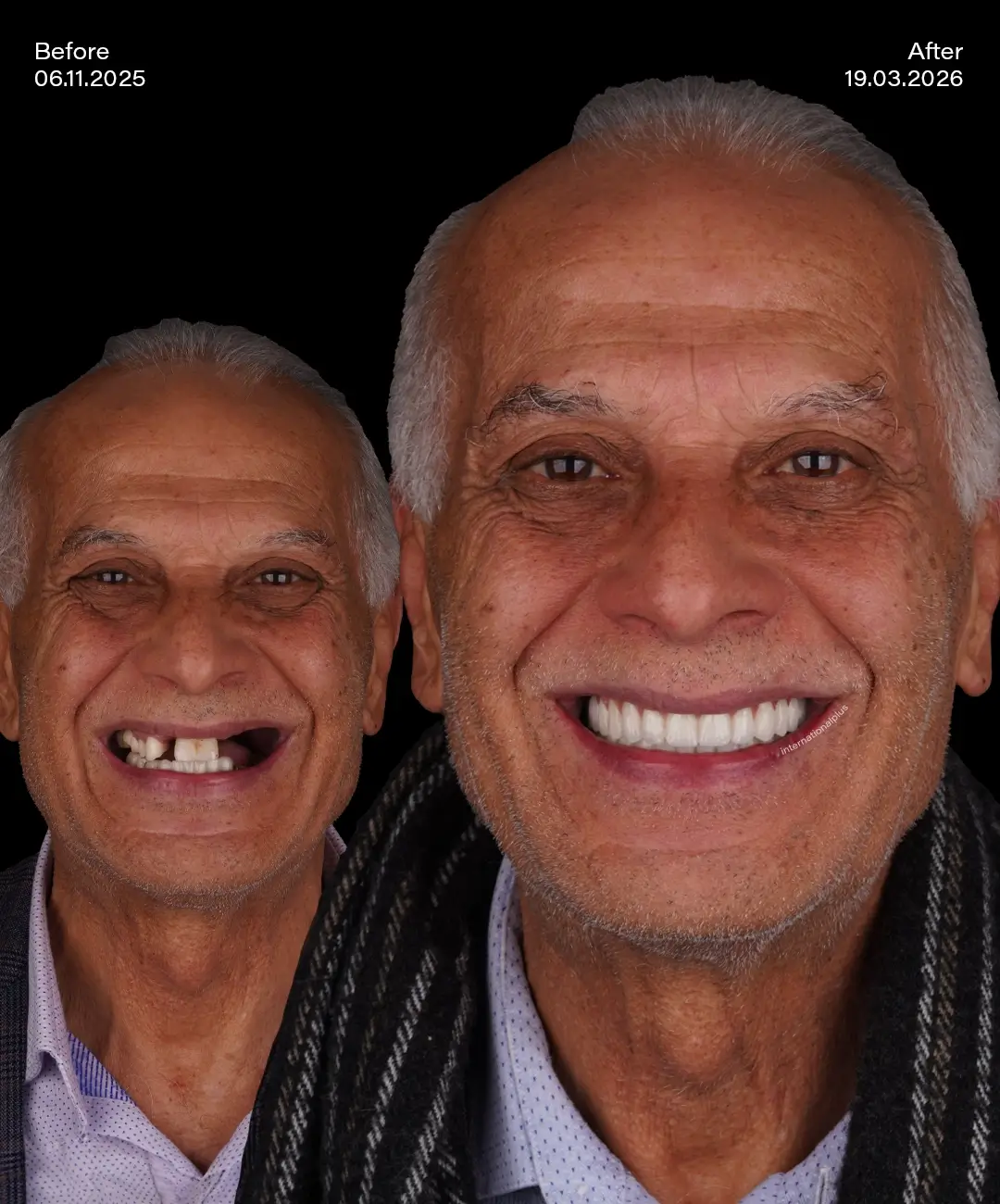 Porcelain Veneers Before After 1