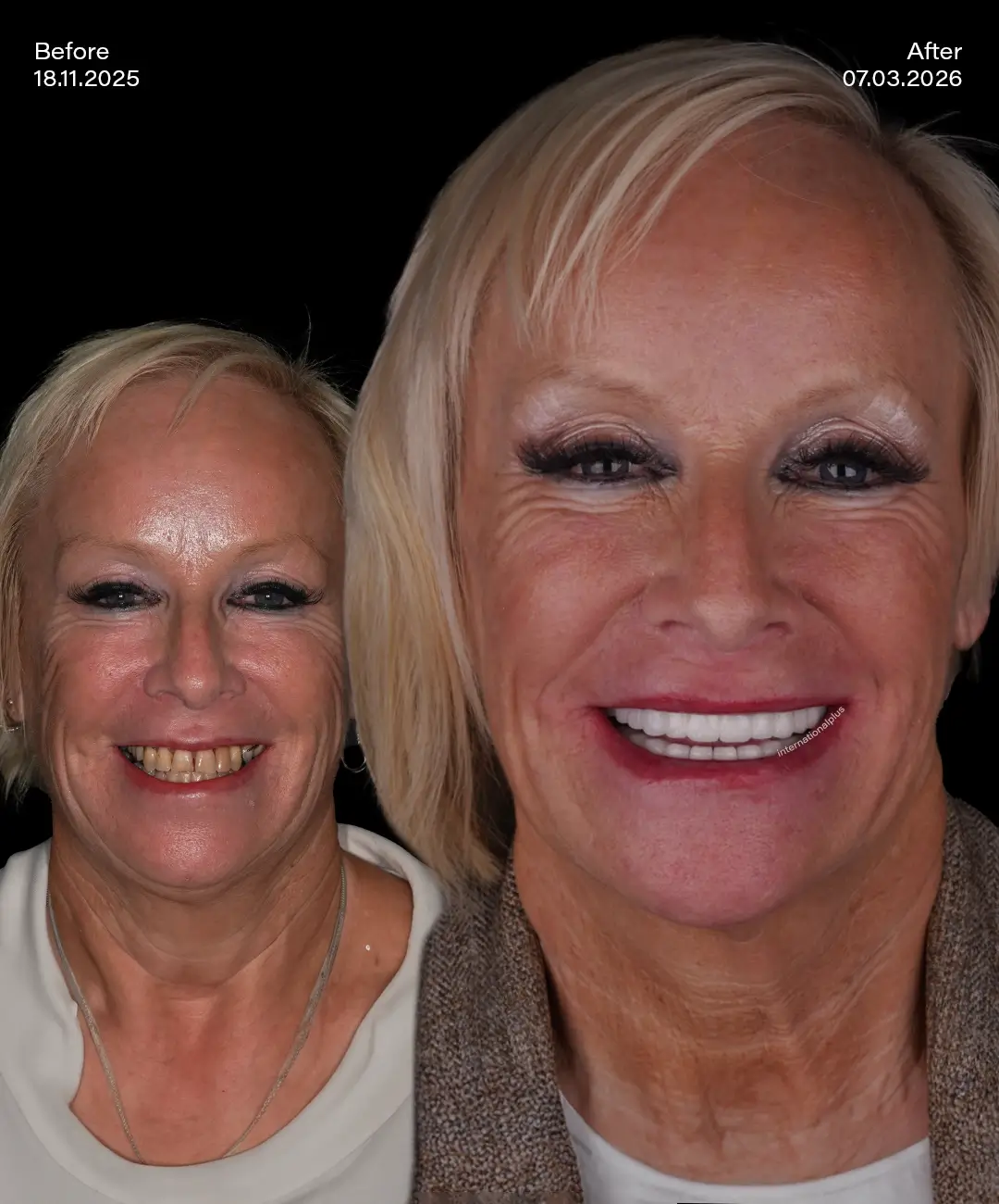 Porcelain Veneers Before After 2
