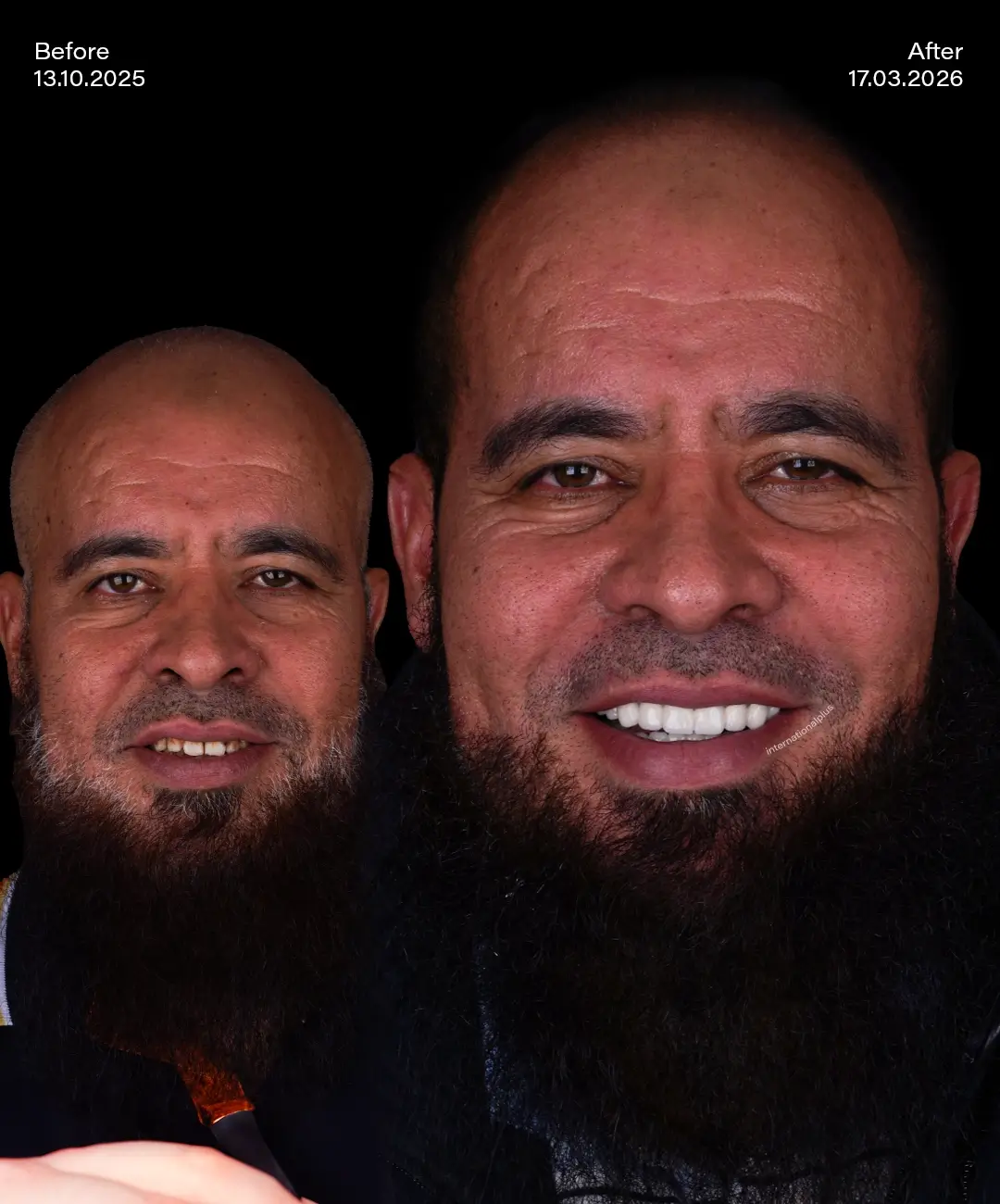Porcelain Veneers Before After 3