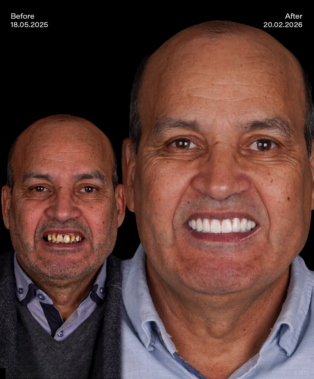 Porcelain Veneers Before After 4
