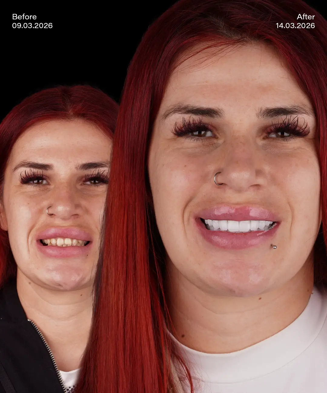 Zirconium Crowns Before After 4