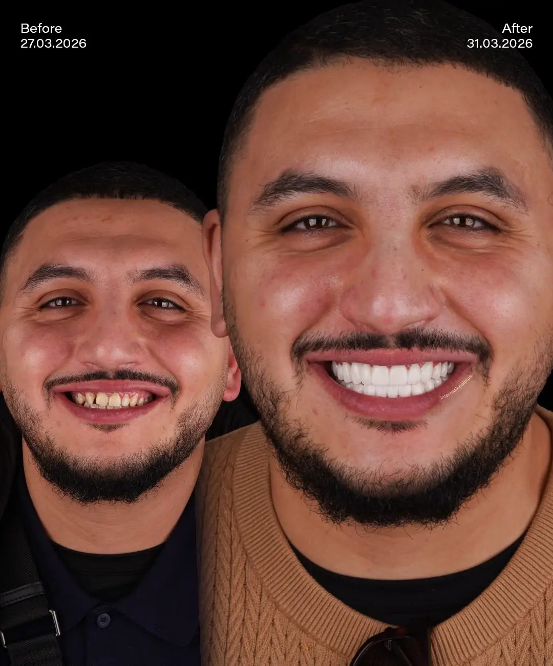 Zirconium Crowns Before After 7