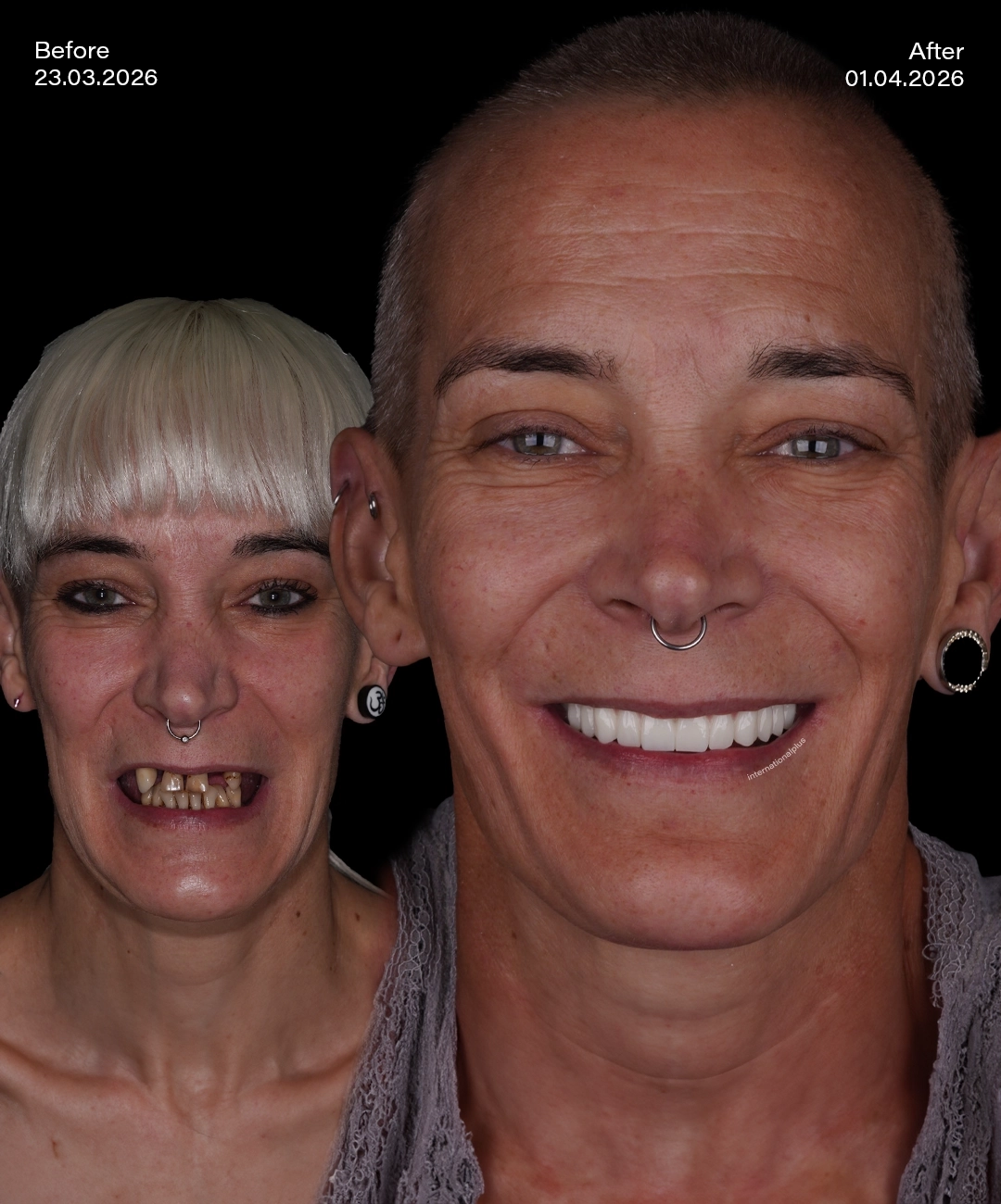 All on 6 Implants Before After 6