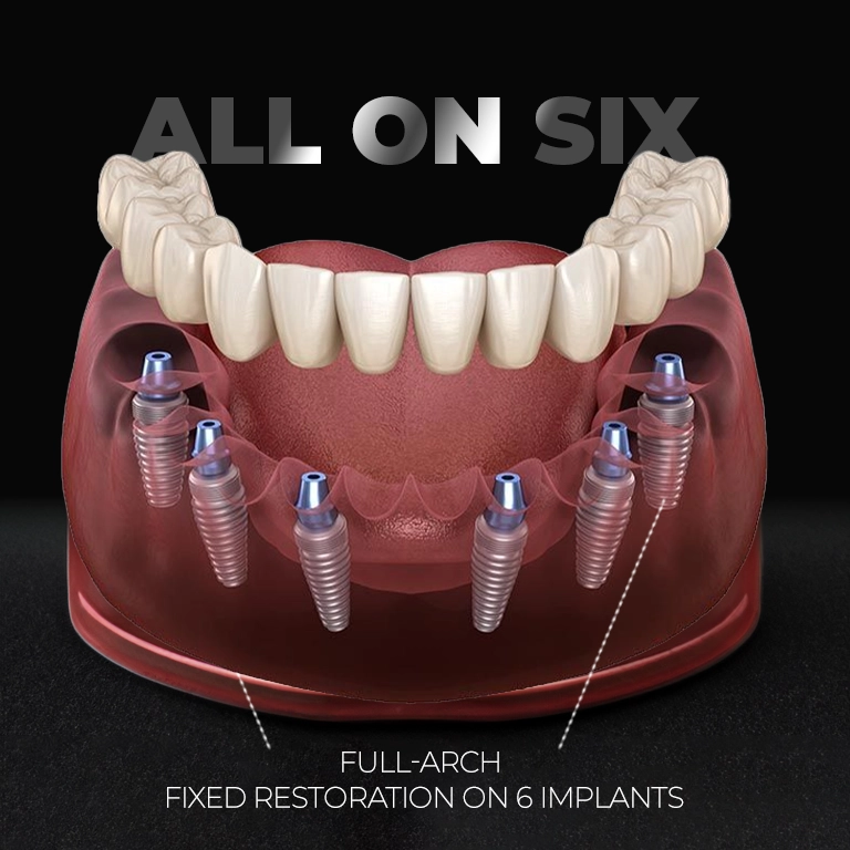 All on 6 Implants ın Turkey Istanbul