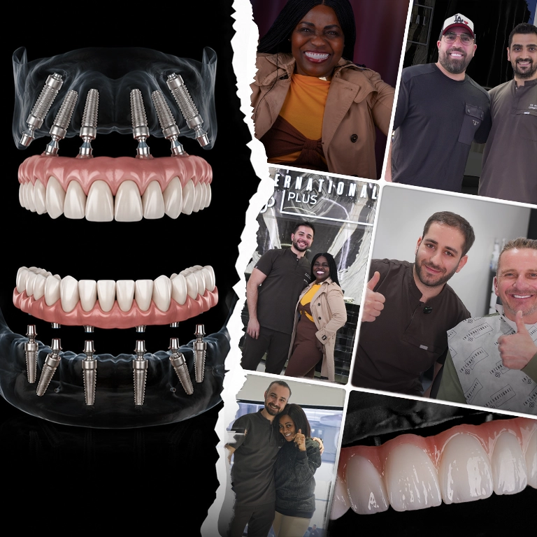 Why Choose Istanbul for All on 6 Implants