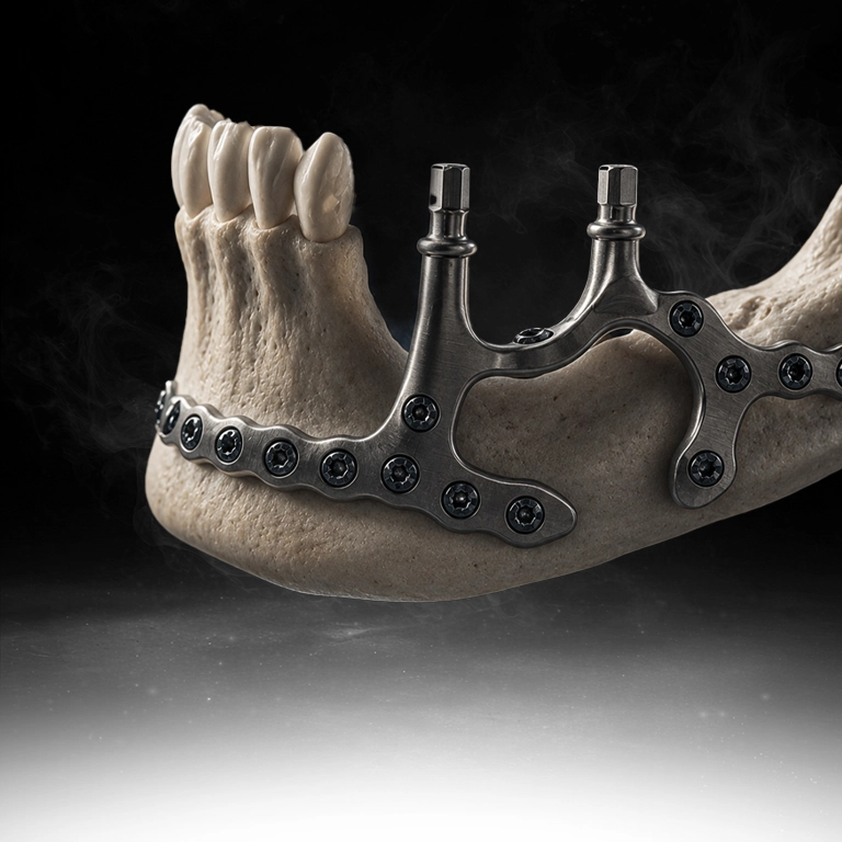 Custom implants