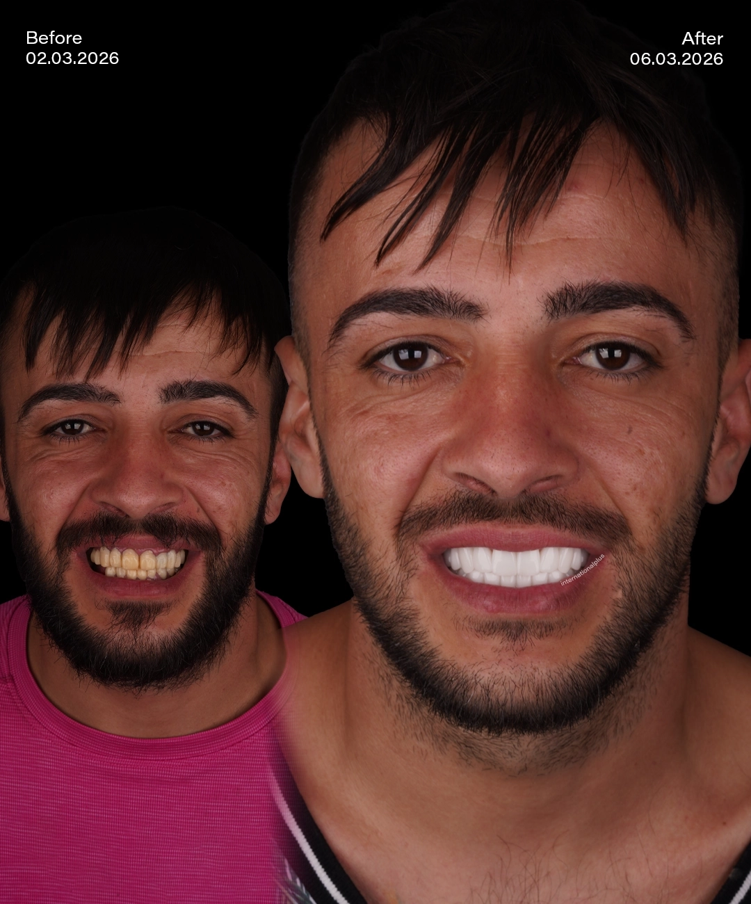 dental-implant-before-after-2
