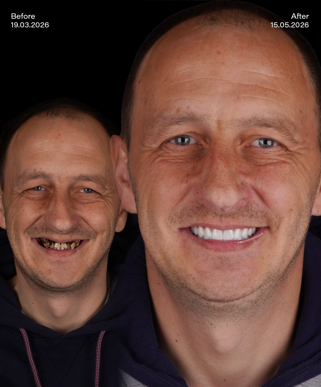 dental-implant-before-after-5
